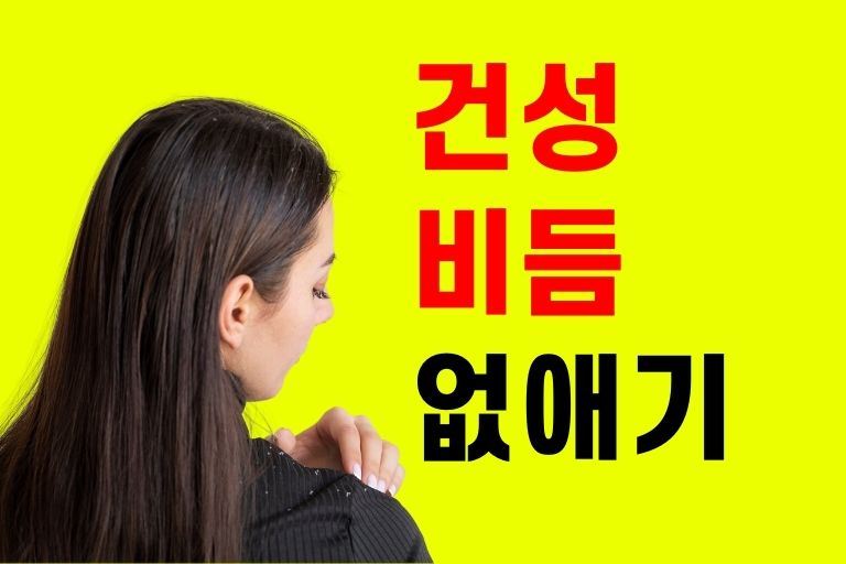 건성비듬 없애는 법